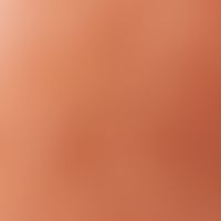 Keratosis actinica. Auflichtmikroskopie: Pigmentierte aktinische Keratose (Wangenregion). Interfo...
