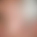 Keratosis actinica. Multiple, nur im Gesicht lokalisierte, chronisch stationäre, disseminierte, 0...