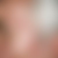 Keratosis actinica. Multiple, nur im Gesicht lokalisierte, chronisch stationäre, disseminierte, 0...