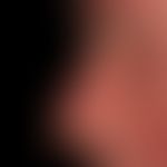 Keratosis actinica keratotischer Typ: Ausgedehnte sog. Feldkanzerisierung mit flächenhaftem Befal...