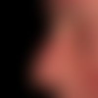 Keratosis actinica keratotischer Typ: Ausgedehnte sog. Feldkanzerisierung mit flächenhaftem Befal...