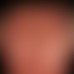 Keratosis actinica. Multiple entzündliche aktinische Keratosen, stellenweise erosiv oder krustig ...