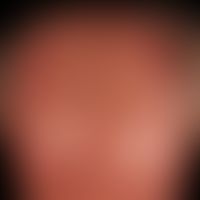 Keratosis actinica. Multiple entzündliche aktinische Keratosen, stellenweise erosiv oder krustig ...