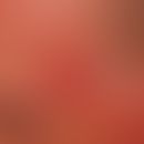 Keratosis actinica erythematous type: Large, blurred, red, rough plaque that is painful on contac...