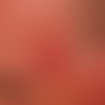 Keratosis actinica erythematöser Typ:. Großflächige ,unscharf begrenzte, rote, raue Plaque, die b...