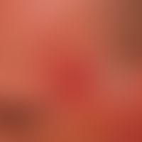 Keratosis actinica erythematöser Typ:. Großflächige ,unscharf begrenzte, rote, raue Plaque, die b...