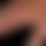 Keratosis actinica (überwiegend) lichenoider Typ: Flächenhafte, scharf begrenzte rote Patches und...
