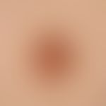 Keratosis areolae mammae naeviformis. Chronisch stationäre, seit Jahren unveränderte, auf Brustwa...