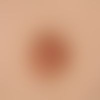 Keratosis areolae mammae naeviformis. Chronisch stationäre, seit Jahren unveränderte, auf Brustwa...