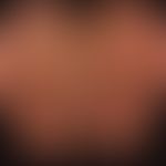Keratosis palmoplantaris diffusa mit Mutationen in Keratin 1: diffuse Palmoplantarkeratose mit ve...
