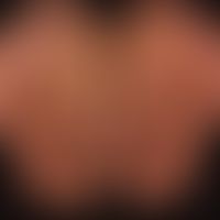 Keratosis palmoplantaris diffusa mit Mutationen in Keratin 1: diffuse Palmoplantarkeratose mit ve...