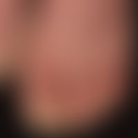 Keratosis extremitatum hereditaria transgrediens et progrediens. transgredients (beyond the later...