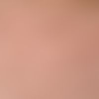 Keratosis pilaris (follicularis): entzündliche, follikulär gebundene Papeln im Bereich des Nacken...