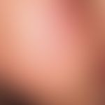 Keratosis follicularis: Follicle-bound, pointed conical horn plugs of the cheek region in a 12-ye...