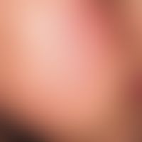 Keratosis pilaris (follicularis):&nbsp;follikelgebundene, spitzkegelige Hornpfröpfe der Wangenreg...