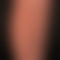 Keratosis pilaris (follicularis): Entzündliche, follikulär gebundene Hornpapeln am Unterschenkel.
