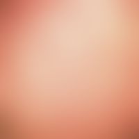 Keratosis follicularis akneiformis, type Siemens. Disseminated, follicular hyperkeratosis of the ...