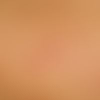 Keratosis lichenoides chronica: Generalized exanthema of scaly, lichenoid papules in a linear arr...