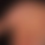 Palmoplantarkeratosen (PKK):&nbsp;Palmoplantarkeratose mit Mutation in KTR1 (historische Bezeichn...