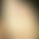 Keratosis palmoplantaris circumscripta seu areata: circumscribed, firmly adhering keratosis on th...