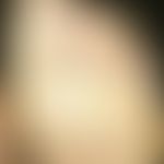 Keratosis palmoplantaris circumscripta seu areata. Umschriebene, fest haftende Keratose an der Fu...