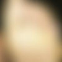 Keratosis palmoplantaris circumscripta seu areata. Umschriebene, fest haftende Keratose an der Fu...