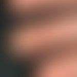 Keratosis palmoplantaris circumscripta seu areata. Übersichtsaufnahme: Seit Geburt bestehende, ve...