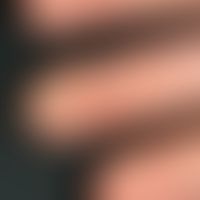 Keratosis palmoplantaris circumscripta seu areata. Übersichtsaufnahme: Seit Geburt bestehende, ve...