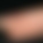 Keratosis palmoplantaris circumscripta seu areata. Ansicht von lateral: Seit Geburt bestehende, v...