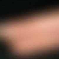 Keratosis palmoplantaris circumscripta seu areata. Ansicht von lateral: Seit Geburt bestehende, v...
