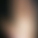 Keratosis palmoplantaris cum degeneratione granulosa. 25-year-old man has a chronic, congenital, ...