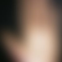 Keratosis palmoplantaris cum degeneratione granulosa. 25-year-old man has a chronic, congenital, ...