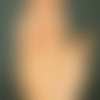 Keratosis palmoplantaris diffusa circumscripta. Angeborene, massive, gleichmäßig verteilte, wachs...