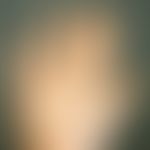 Keratosis palmoplantaris diffusa circumscripta. 2-year-old boy has a chronic, congenital, smooth,...