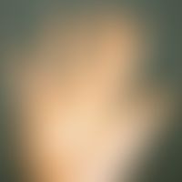 Keratosis palmoplantaris diffusa circumscripta. Bei dem 2-jährigen Jungen besteht eine chronische...