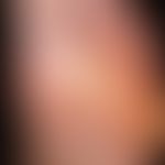 keratosis palmoplantaris papulosa seu maculosa. severe keratosis of the planta pedum in a 26-year...