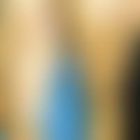 Dermatitis, Berloque-Dermatitis. sharply defined stripy, centrally scaling hyperpigmentation in t...