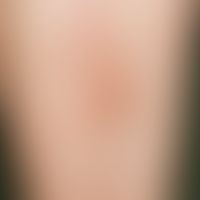 Dermatitis, Berloque dermatitis: Acute, bizarrely configured, sharply defined, intensely burning ...