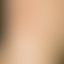 Dermatitis bullosa pratensis: streifig angeordnete, juckende und brennende Erytheme mit Blasenbil...