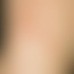 Dermatitis bullosa pratensis: streifig angeordnete, juckende und brennende Erytheme mit Blasenbil...