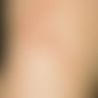 Dermatitis bullosa pratensis: streifig angeordnete, juckende und brennende Erytheme mit Blasenbil...