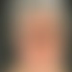Dermatitis, chronische aktinische (Typ aktinisches Retikuloid). Großflächige, chronisch dynamisch...