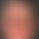 Dermatitis chronische aktinische (Typ lichtprovoziertes atopisches Ekzem). Übersichtsaufnahme: Di...
