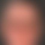 Dermatitis chronische aktinische (Typ lichtprovoziertes atopisches Ekzem). Übersichtsaufnahme: Di...