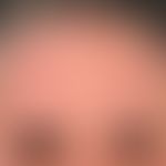 Dermatitis, chronische aktinische. Detailvergrößerung: Disseminierte, zerkratzte Papeln und Knote...
