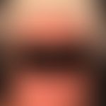 Dermatitis chronische aktinische (Typ aktinisches Retikuloid): Großflächiges,&nbsp;heftig juckend...