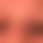Dermatitis chronische aktinische: Schwere flächenhafte, permanent juckende&nbsp;Ekzemreaktion des...