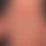 Dermatitis chronische aktinische: Nahezu scharf begrenzte flächige, seit Monaten&nbsp;persistiere...
