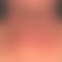 Dermatitis chronic actinic: Chronic laminar eczema reaction which is essentially limited to the e...