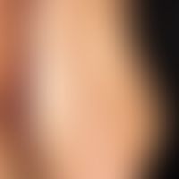 Dermatitis herpetiformis:&nbsp;Disseminierte, meist erodierte Papeln (Vesikeln hier nicht nachwei...